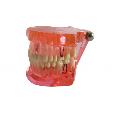 Educational Restoration Model w/Implant