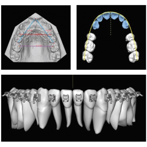 Ortho Insight 3D® Precision Bracket Placement System